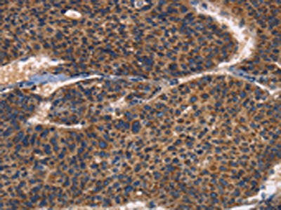 The image on the left is immunohistochemistry of paraffin-embedded Human liver cancer tissue using the antibody Antibody) at dilution 1/30, on the right is treated with fusion protein. (Original magnification: ×200)