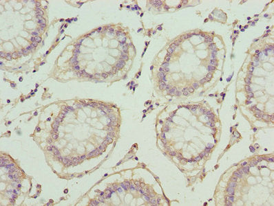 Immunohistochemistry of paraffin-embedded human colon cancer using the antibody at dilution of 1:100Rabbit anti-Human PLA2G7 Polyclonal Antibody