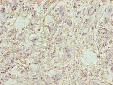 Immunohistochemistry of paraffin-embedded human pancreatic cancer using PLA2G7 Antibody at dilution of 1:100Rabbit anti-Human PLA2G7 Polyclonal Antibody