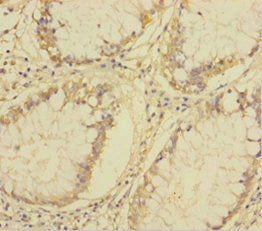 Immunohistochemistry of paraffin-embedded human colon cancer using PLA2G7 Antibody at dilution of 1:100Rabbit anti-Human PLA2G7 Polyclonal Antibody