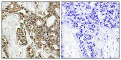 Immunohistochemical analysis of paraffin-embedded human breast carcinoma tissue using p44/42 MAP Kinase (Phospho-Tyr204) Antibody (left) or the same antibody preincubated with blocking peptide (right).