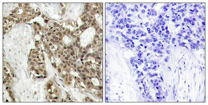 Immunohistochemical analysis of paraffin-embedded human breast carcinoma tissue using p44/42 MAP Kinase (Phospho-Tyr204) Antibody (left) or the same antibody preincubated with blocking peptide (right).