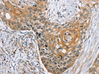 The image on the left is immunohistochemistry of paraffin-embedded Human esophagus cancer tissue using RBM38 Antibody(RBM38 Antibody) at dilution 1/35, on the right is treated with synthetic peptide. (Original magnification: x200)Rabbit anti-Human RBM38 Polyclonal Antibody