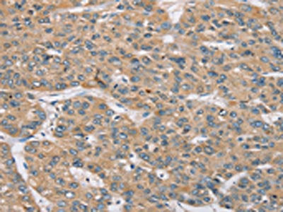 The image on the left is immunohistochemistry of paraffin-embedded Human liver cancer tissue using the antibody Antibody) at dilution 1/35, on the right is treated with synthetic peptide. (Original magnification: x200)Rabbit anti-Human RBM38 Polyclonal Antibody