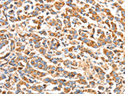The image on the left is immunohistochemistry of paraffin-embedded Human breast cancer tissue using BAK1 Antibody(BAK1 Antibody) at dilution 1/50, on the right is treated with fusion protein. (Original magnification: ×200)