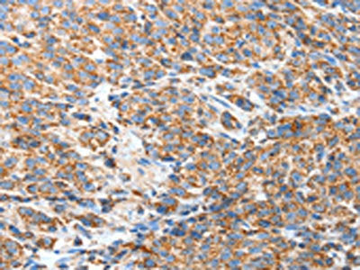 The image on the left is immunohistochemistry of paraffin-embedded Human esophagus cancer tissue using the antibody Antibody) at dilution 1/50, on the right is treated with fusion protein. (Original magnification: ×200)