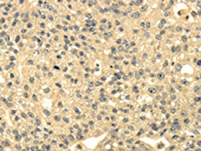 The image on the left is immunohistochemistry of paraffin-embedded Human breast cancer tissue using MSI1 Antibody(MSI1 Antibody) at dilution 1/35, on the right is treated with synthetic peptide. (Original magnification: ×200)Rabbit anti-Human MSI1 Polyclonal Antibody