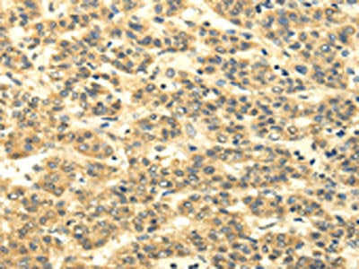 The image on the left is immunohistochemistry of paraffin-embedded Human liver cancer tissue using the antibody Antibody) at dilution 1/35, on the right is treated with synthetic peptide. (Original magnification: ×200)Rabbit anti-Human MSI1 Polyclonal Antibody