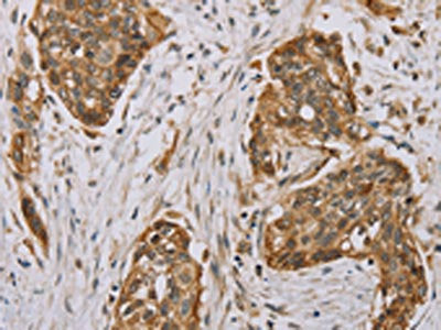 The image on the left is immunohistochemistry of paraffin-embedded Human esophagus cancer tissue using MVK Antibody(MVK Antibody) at dilution 1/40, on the right is treated with fusion protein. (Original magnification: ×200)Rabbit anti-Human MVK Polyclonal Antibody