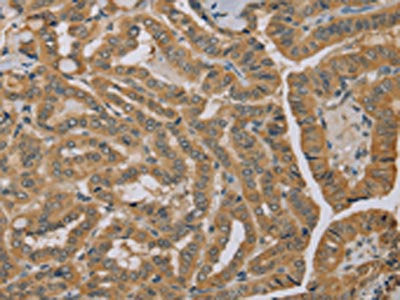 The image on the left is immunohistochemistry of paraffin-embedded Human thyroid cancer tissue using the antibody Antibody) at dilution 1/40, on the right is treated with fusion protein. (Original magnification: ×200)Rabbit anti-Human MVK Polyclonal Antibody