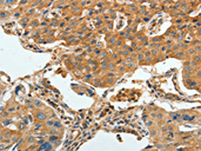 The image on the left is immunohistochemistry of paraffin-embedded Human lung cancer tissue using APPL1 Antibody(APPL1 Antibody) at dilution 1/30, on the right is treated with fusion protein. (Original magnification: ×200)