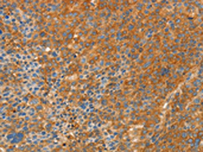 The image on the left is immunohistochemistry of paraffin-embedded Human liver cancer tissue using the antibody Antibody) at dilution 1/30, on the right is treated with fusion protein. (Original magnification: ×200)