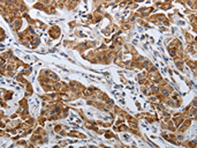 The image on the left is immunohistochemistry of paraffin-embedded Human lung cancer tissue using SPAG1 Antibody(SPAG1 Antibody) at dilution 1/25, on the right is treated with synthetic peptide. (Original magnification: ×200)Rabbit anti-Human SPAG1 Polyclonal Antibody