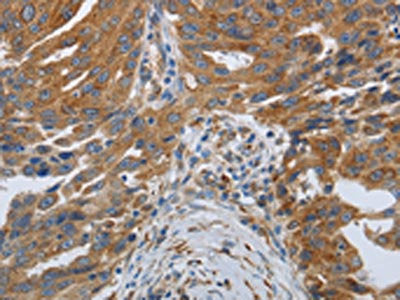 The image on the left is immunohistochemistry of paraffin-embedded Human ovarian cancer tissue using the antibody Antibody) at dilution 1/25, on the right is treated with synthetic peptide. (Original magnification: ×200)Rabbit anti-Human SPAG1 Polyclonal Antibody
