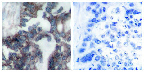 Immunohistochemical analysis of paraffin-embedded human breast carcinoma tissue using p70 S6 Kinase(Ab-424) Antibody(left) or the same antibody preincubated with blocking peptide(right).Rabbit anti-Human RPS6KB1 Polyclonal Antibody