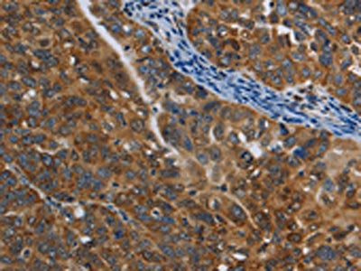 The image on the left is immunohistochemistry of paraffin-embedded Human ovarian cancer tissue using COX6B2 Antibody(COX6B2 Antibody) at dilution 1/50, on the right is treated with fusion protein. (Original magnification: ×200)Rabbit anti-Human COX6B2 Polyclonal Antibody
