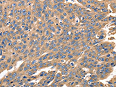 The image on the left is immunohistochemistry of paraffin-embedded Human ovarian cancer tissue using IRF1 Antibody(IRF1 Antibody) at dilution 1/40, on the right is treated with synthetic peptide. (Original magnification: ×200)