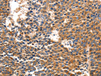 The image on the left is immunohistochemistry of paraffin-embedded Human liver cancer tissue using the antibody Antibody) at dilution 1/40, on the right is treated with synthetic peptide. (Original magnification: ×200)