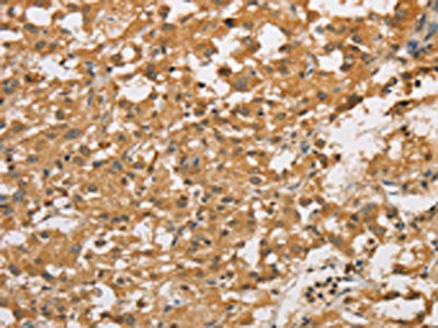 The image on the left is immunohistochemistry of paraffin-embedded Human thyroid cancer tissue using the antibody Antibody) at dilution 1/50, on the right is treated with fusion protein. (Original magnification: ×200)