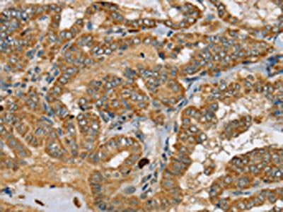 The image on the left is immunohistochemistry of paraffin-embedded Human thyroid cancer tissue using SEC14L2 Antibody(SEC14L2 Antibody) at dilution 1/25, on the right is treated with synthetic peptide. (Original magnification: ×200)Rabbit anti-Human SEC14L2 Polyclonal Antibody