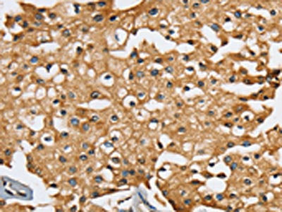 The image on the left is immunohistochemistry of paraffin-embedded Human prostate cancer tissue using the antibody Antibody) at dilution 1/25, on the right is treated with synthetic peptide. (Original magnification: ×200)Rabbit anti-Human SEC14L2 Polyclonal Antibody