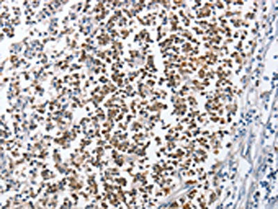 The image on the left is immunohistochemistry of paraffin-embedded Human tonsil tissue using MCM6 Antibody(MCM6 Antibody) at dilution 1/45, on the right is treated with fusion protein. (Original magnification: ×200)