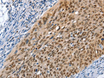 The image on the left is immunohistochemistry of paraffin-embedded Human cervical cancer tissue using the antibody Antibody) at dilution 1/45, on the right is treated with fusion protein. (Original magnification: ×200)