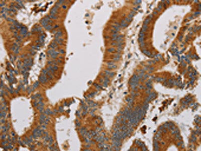 The image on the left is immunohistochemistry of paraffin-embedded Human colon cancer tissue using CCR8 Antibody(CCR8 Antibody) at dilution 1/20, on the right is treated with synthetic peptide. (Original magnification: ×200)Rabbit anti-Human CCR8 Polyclonal Antibody
