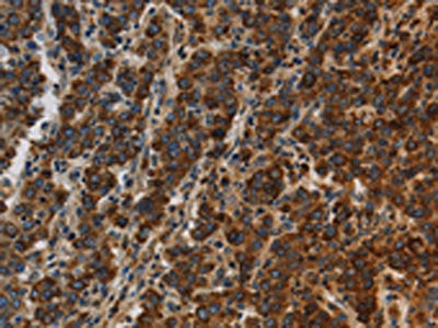 The image on the left is immunohistochemistry of paraffin-embedded Human liver cancer tissue using the antibody Antibody) at dilution 1/20, on the right is treated with synthetic peptide. (Original magnification: ×200)