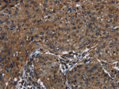 The image on the left is immunohistochemistry of paraffin-embedded Human esophagus cancer tissue using HOXC8 Antibody(HOXC8 Antibody) at dilution 1/25, on the right is treated with synthetic peptide. (Original magnification: ×200)Rabbit anti-Human HOXC8 Polyclonal Antibody