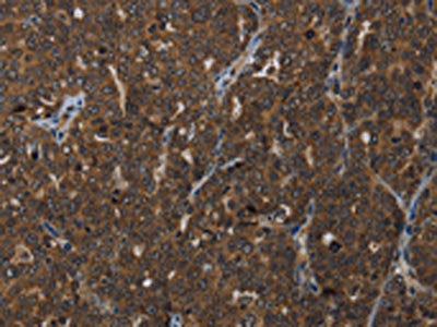 The image on the left is immunohistochemistry of paraffin-embedded Human ovarian cancer tissue using the antibody Antibody) at dilution 1/25, on the right is treated with synthetic peptide. (Original magnification: ×200)Rabbit anti-Human HOXC8 Polyclonal Antibody