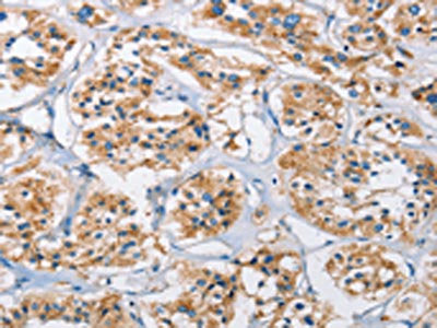 The image on the left is immunohistochemistry of paraffin-embedded Human thyroid cancer tissue using CTSL Antibody(CTSL Antibody) at dilution 1/40, on the right is treated with fusion protein. (Original magnification: ×200)Rabbit anti-Human CTSL Polyclonal Antibody