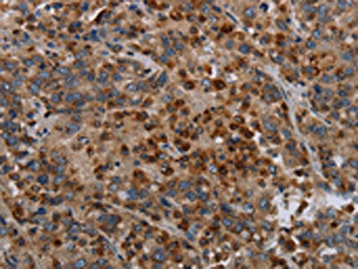 The image on the left is immunohistochemistry of paraffin-embedded Human liver cancer tissue using MAP3K11 Antibody(MAP3K11 Antibody) at dilution 1/40, on the right is treated with synthetic peptide. (Original magnification: ×200)