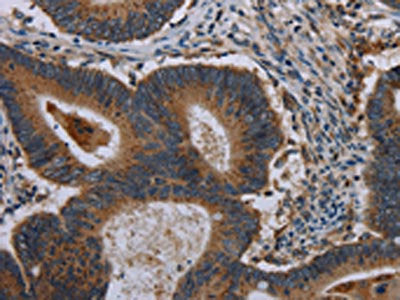 The image on the left is immunohistochemistry of paraffin-embedded Human colon cancer tissue using the antibody Antibody) at dilution 1/40, on the right is treated with synthetic peptide. (Original magnification: ×200)