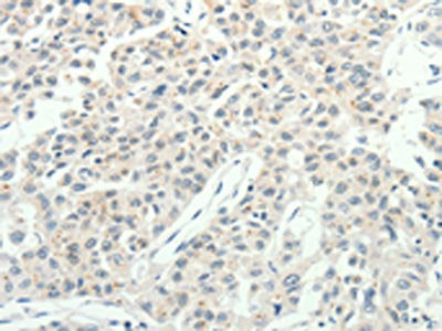 The image on the left is immunohistochemistry of paraffin-embedded Human lung cancer tissue using RPAP3 Antibody(RPAP3 Antibody) at dilution 1/20, on the right is treated with fusion protein. (Original magnification: ×200)Rabbit anti-Human RPAP3 Polyclonal Antibody
