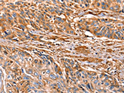 The image on the left is immunohistochemistry of paraffin-embedded Human esophagus cancer tissue using LGALS1 Antibody(LGALS1 Antibody) at dilution 1/25, on the right is treated with fusion protein. (Original magnification: ×200)