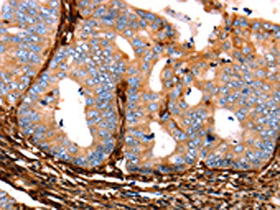 The image on the left is immunohistochemistry of paraffin-embedded Human cervical cancer tissue using the antibody Antibody) at dilution 1/25, on the right is treated with fusion protein. (Original magnification: ×200)