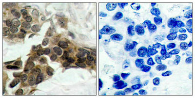 Immunohistochemical analysis of paraffin-embedded human breast carcinoma tissue using IkB-a(Phospho-Ser32/Ser36) Antibody(left) or the same antibody preincubated with blocking peptide(right).Rabbit anti-Human NFKBIA Polyclonal Antibody