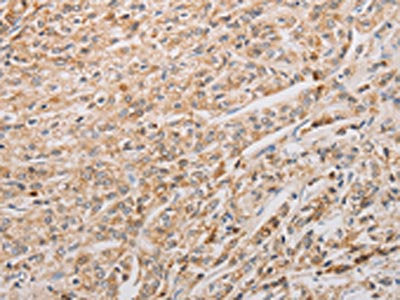 The image on the left is immunohistochemistry of paraffin-embedded Human prostate cancer tissue using BNIP3 Antibody(BNIP3 Antibody) at dilution 1/20, on the right is treated with fusion protein. (Original magnification: ×200)