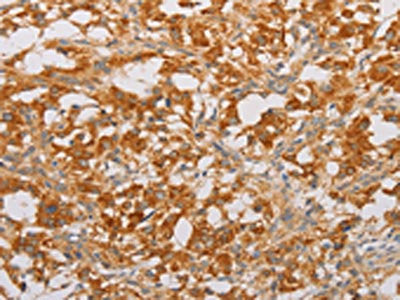 The image on the left is immunohistochemistry of paraffin-embedded Human thyroid cancer tissue using the antibody Antibody) at dilution 1/20, on the right is treated with fusion protein. (Original magnification: ×200)