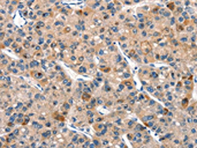 The image on the left is immunohistochemistry of paraffin-embedded Human liver cancer tissue using DUSP2 Antibody(DUSP2 Antibody) at dilution 1/30, on the right is treated with synthetic peptide. (Original magnification: ×200)Rabbit anti-Human DUSP2 Polyclonal Antibody