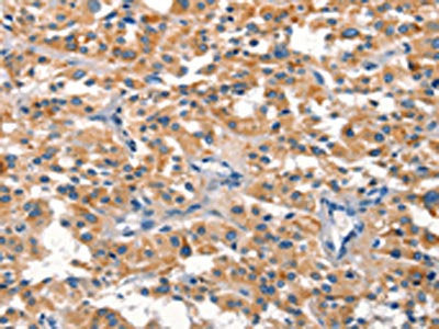 The image on the left is immunohistochemistry of paraffin-embedded Human thyroid cancer tissue using the antibody Antibody) at dilution 1/30, on the right is treated with synthetic peptide. (Original magnification: ×200)Rabbit anti-Human DUSP2 Polyclonal Antibody