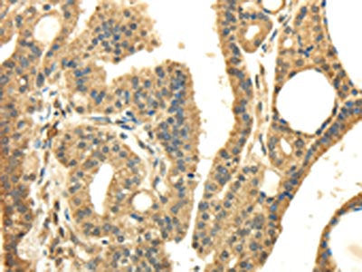 The image on the left is immunohistochemistry of paraffin-embedded Human thyroid cancer tissue using PMP2 Antibody(PMP2 Antibody) at dilution 1/25, on the right is treated with fusion protein. (Original magnification: ×200)Rabbit anti-Human PMP2 Polyclonal Antibody
