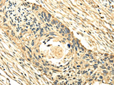 The image on the left is immunohistochemistry of paraffin-embedded Human esophagus cancer tissue using the antibody Antibody) at dilution 1/25, on the right is treated with fusion protein. (Original magnification: ×200)Rabbit anti-Human PMP2 Polyclonal Antibody