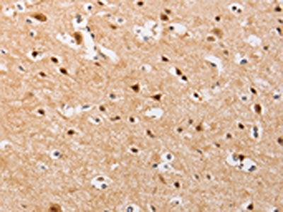The image on the left is immunohistochemistry of paraffin-embedded Human brain  tissue using PIP5K1A Antibody(PIP5K1A Antibody) at dilution 1/30, on the right is treated with fusion protein. (Original magnification: ×200)Rabbit anti-Human PIP5K1A Polyclonal Antibody