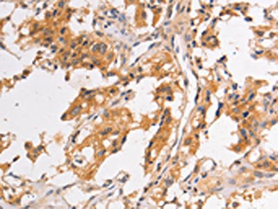 The image on the left is immunohistochemistry of paraffin-embedded Human thyroid cancer tissue using the antibody Antibody) at dilution 1/30, on the right is treated with fusion protein. (Original magnification: ×200)Rabbit anti-Human PIP5K1A Polyclonal Antibody