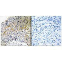 Immunohistochemical analysis of paraffin-embedded human breast carcinoma tissue using p130 Cas (Ab-410) antibody.