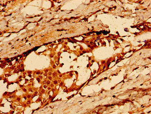Immunohistochemistry of paraffin-embedded human breast cancer using CD36 Antibody at dilution of 1:100Rabbit anti-Human CD36 Polyclonal Antibody