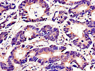 Immunohistochemistry of paraffin-embedded human colon cancer using TUBA4A Antibody at dilution of 1:100Rabbit anti-Human TUBA4A Polyclonal Antibody