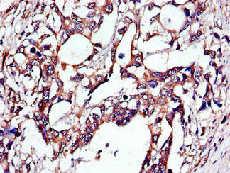 Immunohistochemistry of paraffin-embedded human gastric cancer using TUBA4A Antibody at dilution of 1:100Rabbit anti-Human TUBA4A Polyclonal Antibody